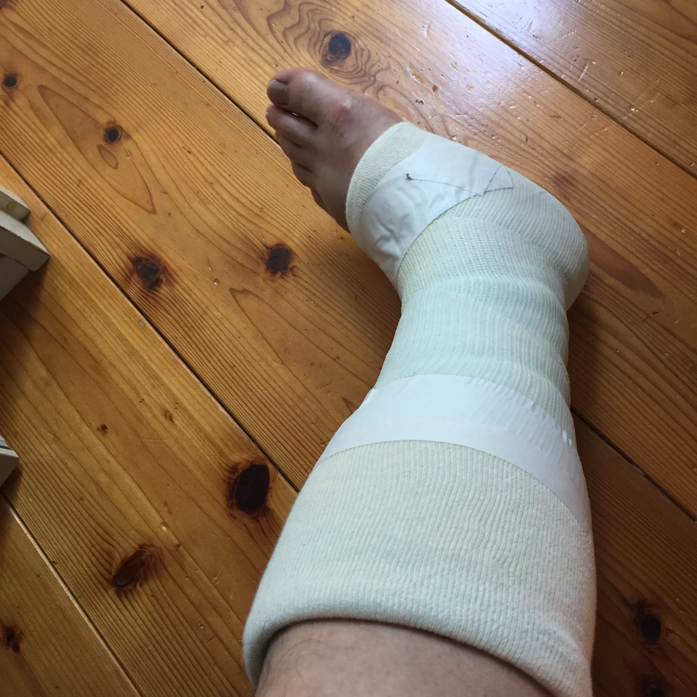 骨折してしまいました…／姫路市の美容院／美容室／ヘアサロン ｜姫路の美容院 Berea（ベレア）
